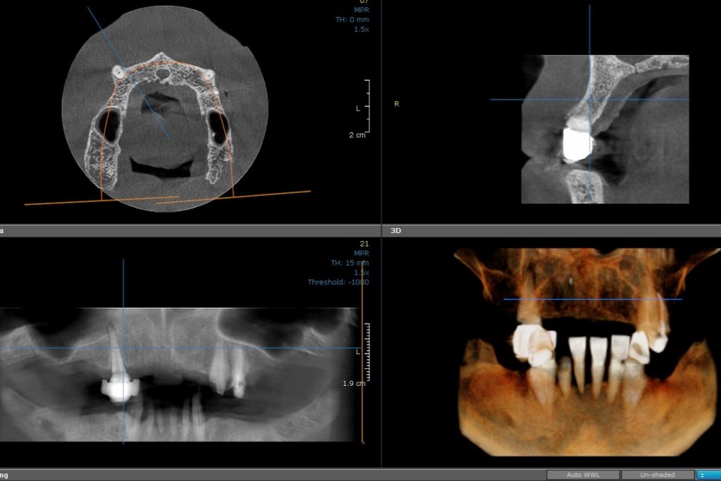 CBCT Maxilla