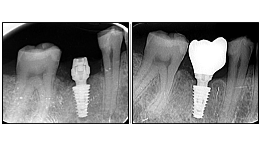 Comparative radiographic study of crestal bone stability: OAOT protocol. Postoperative radiography vs. Final prosthetics.