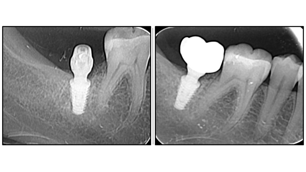 Stable peri implant tissue