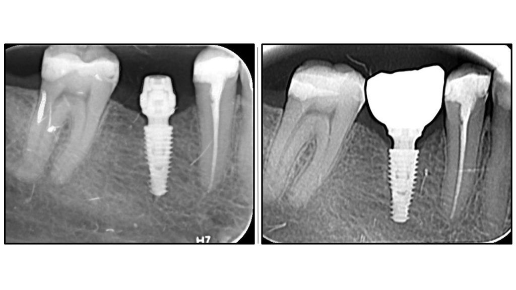 OAOT protocol - superior results.