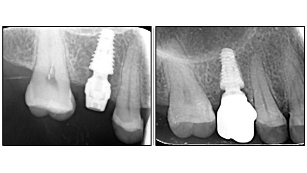 Bicortical stability achieved by the abutment.