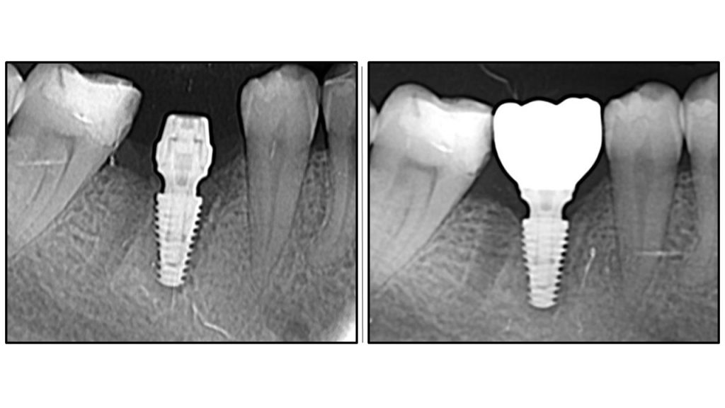 immediate implant placement with oaot
