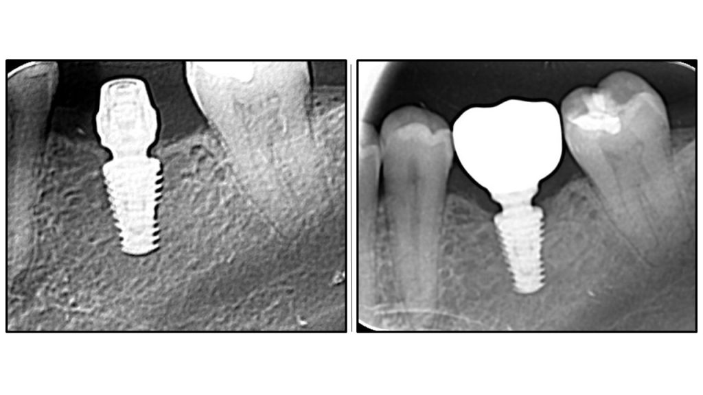 Слајд 7 - Имплантологија без графтова још један пример успешног ремоделирања кости око абатмента.