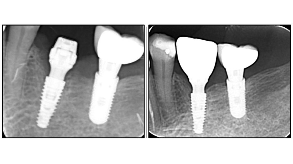 Слајд 8 - Имплантологија без графтова Поређење супериорности OAOT у односу на поновљено искључивање.