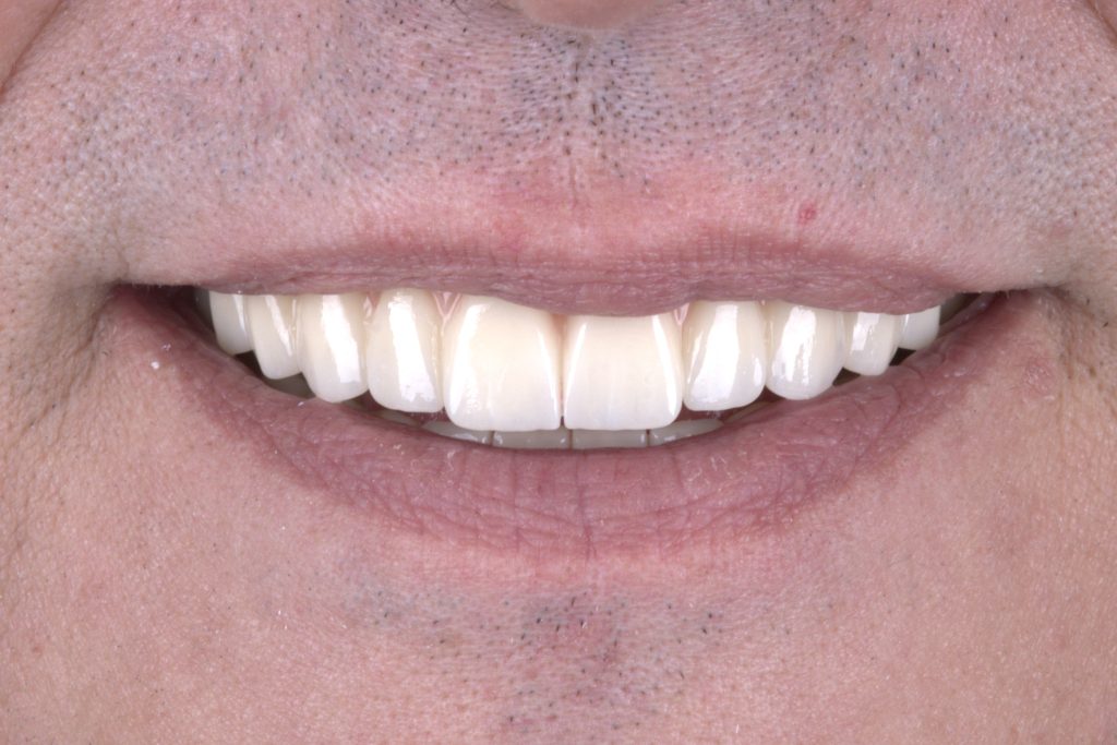 Final monolithic zirconia restoration for a double All-on-4 case study.