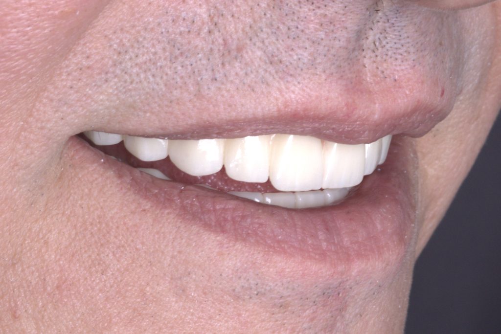 Precision-engineered occlusion, expertly crafted by our lab at White Clinic Belgrade.