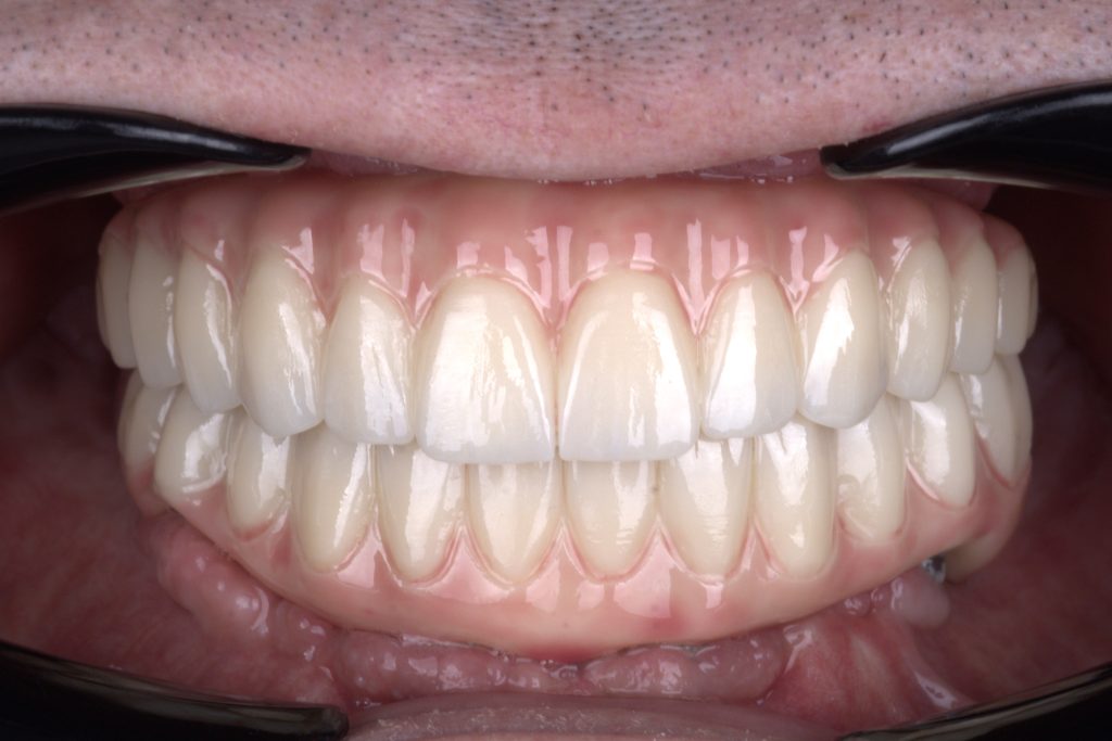 The beauty of precision: Capturing the perfect bite in monolithic zirconia.