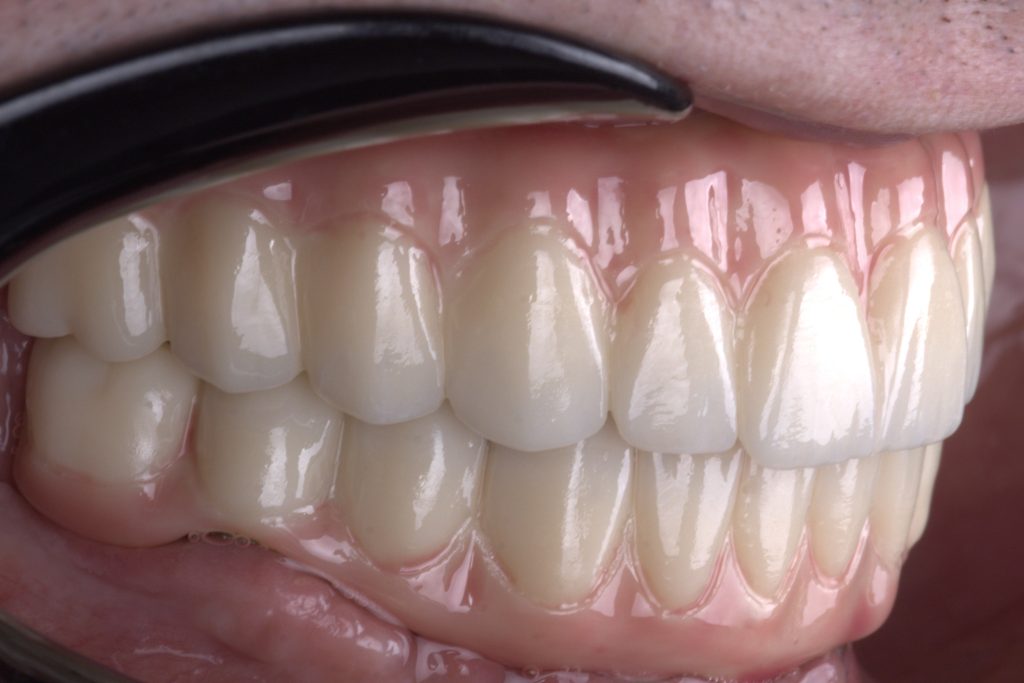 Visual satisfaction: The seamless occlusion of monolithic zirconia at White Clinic Belgrade.