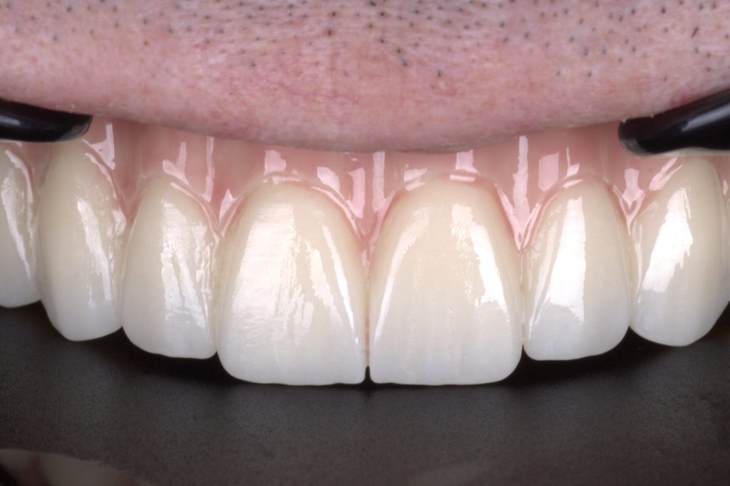 Exquisite incisal edges and perfect occlusion in full-contour zirconia.