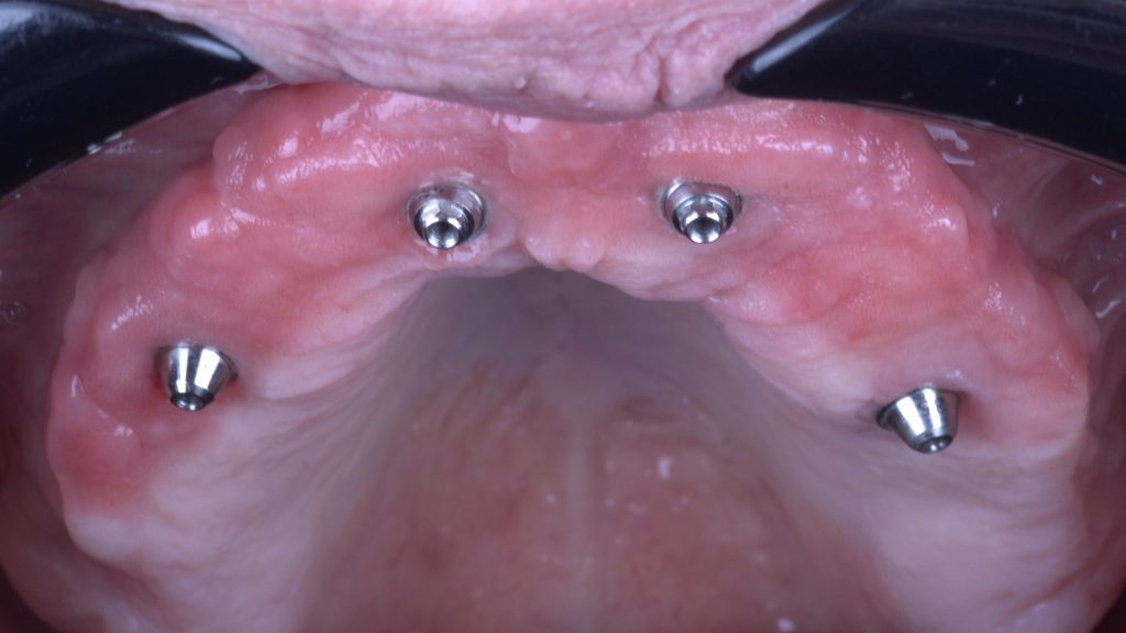 all on 4 gingiva gore - Graft Free Implantology