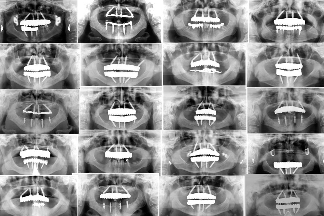 The Fallacy of “All-on-X”: Why Protocol Trumps Implant Count