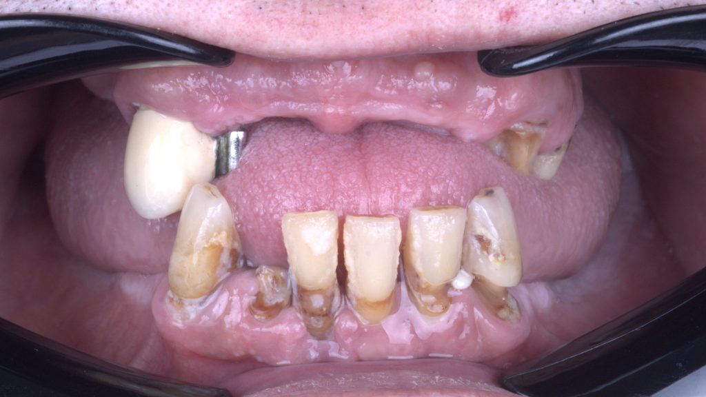 Terminal dentition.