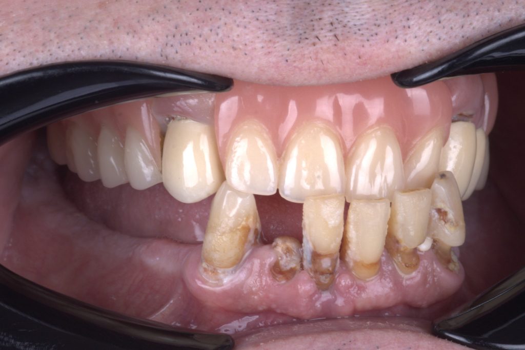 Делимична протеза на горњој вилици и каријес корена и пародонтална болест на доњој вилици.