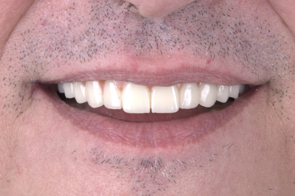 PMMA provisional All on 4 bridge