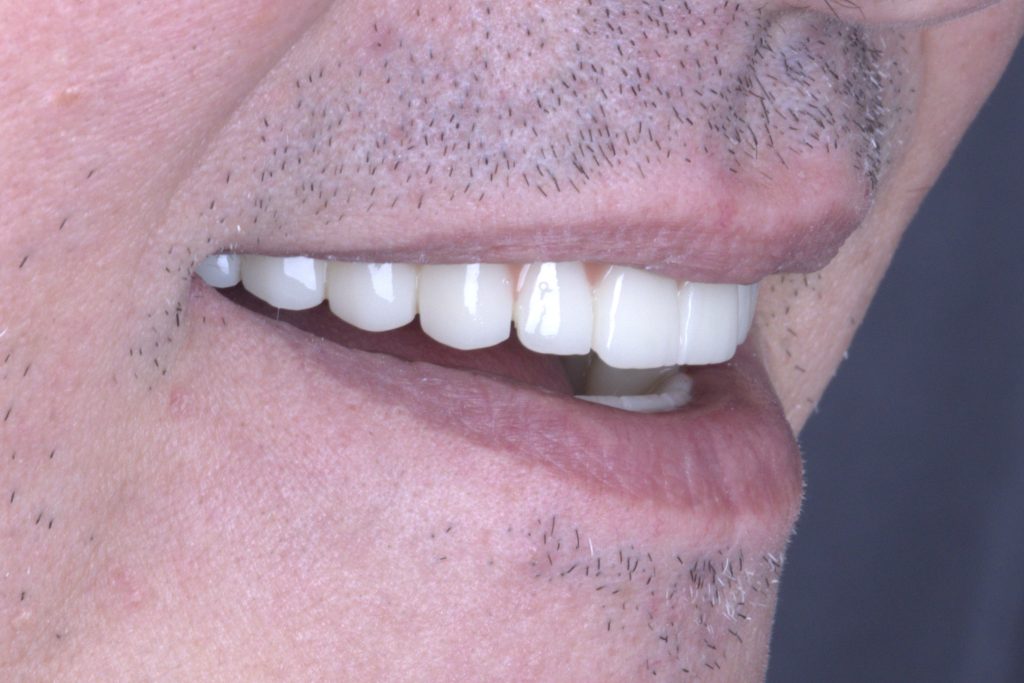 Immediate loading with PMMA temporary bridge - White Clinic Belgrade