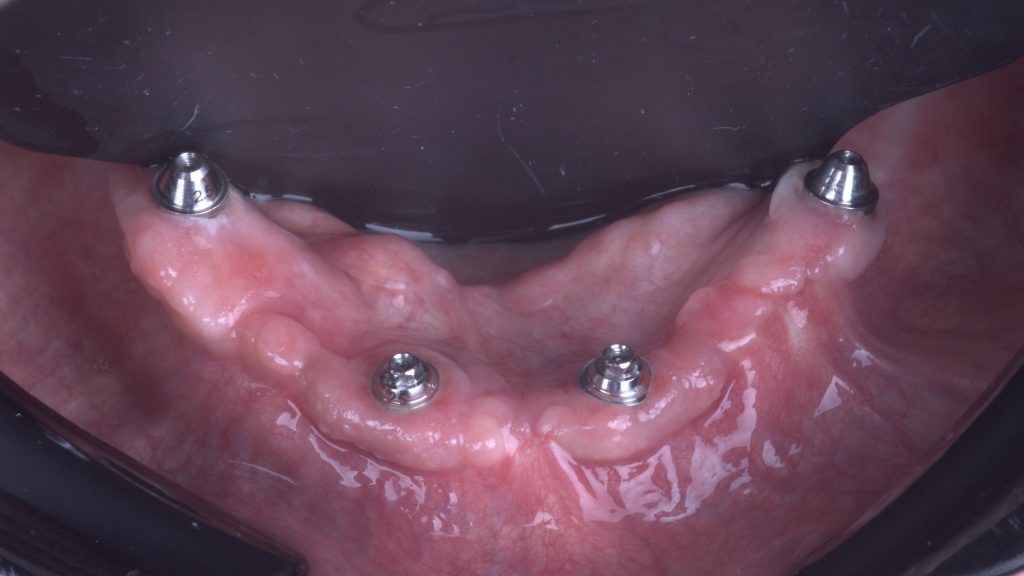 Keratinized peri-implant mucosa