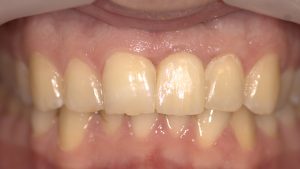 bdf final crown - Graft Free Implantology