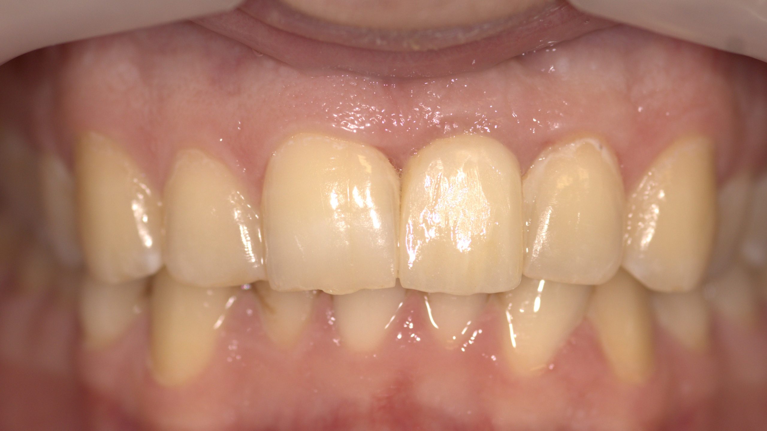 Case: Buccaly Displaced Flap