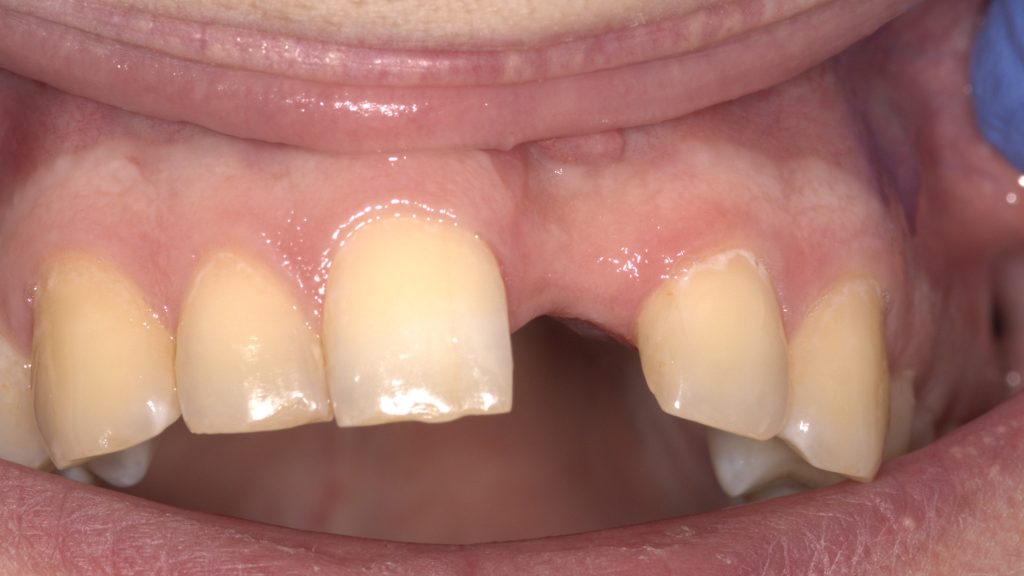 bdf flap pre - Graft Free Implantology