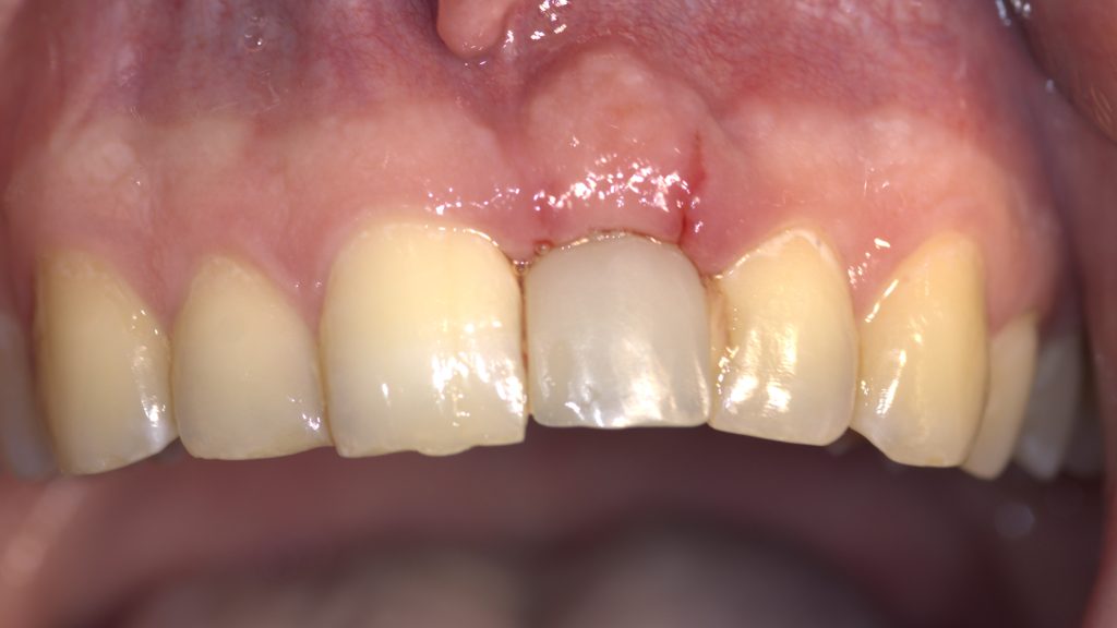 bdf postop 7 dana - Graft Free Implantology