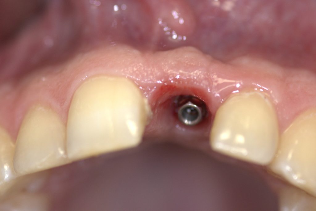 bdf pre protetike - Graft Free Implantology