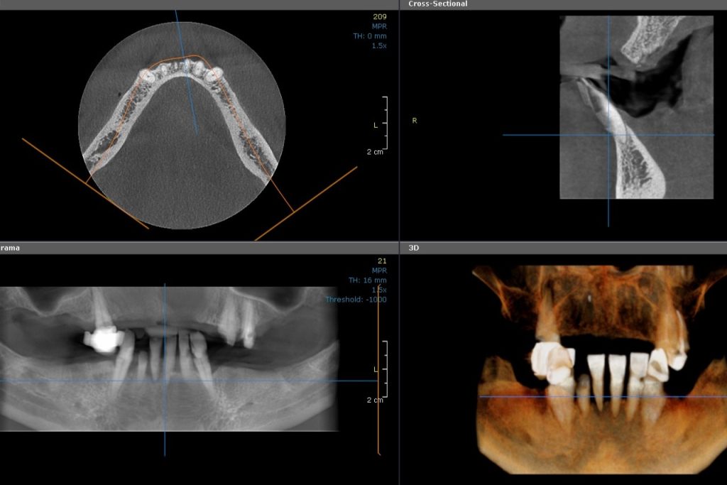 CBCT Mandibula