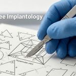 A mucoperiosteal flap design for minimally invasive approach.