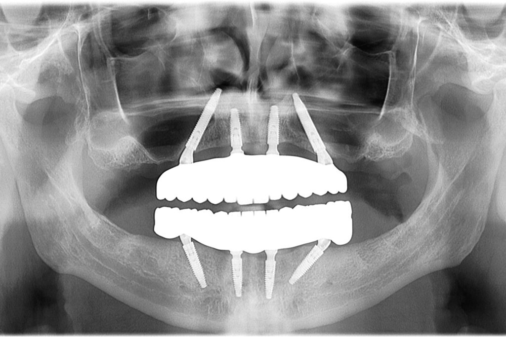Рентгенски снимак контроле показује оптимално нагибање имплантата за двоструку All-on-4 стабилност и савршено прилагођавање цирконије.
