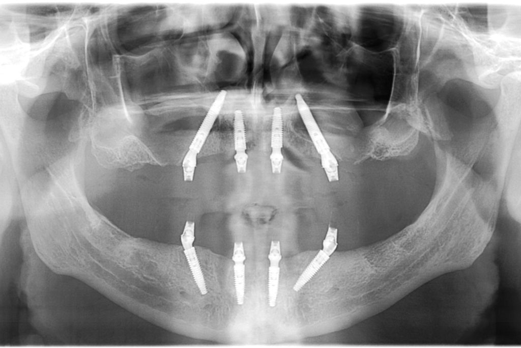 Panoramic X-ray scan