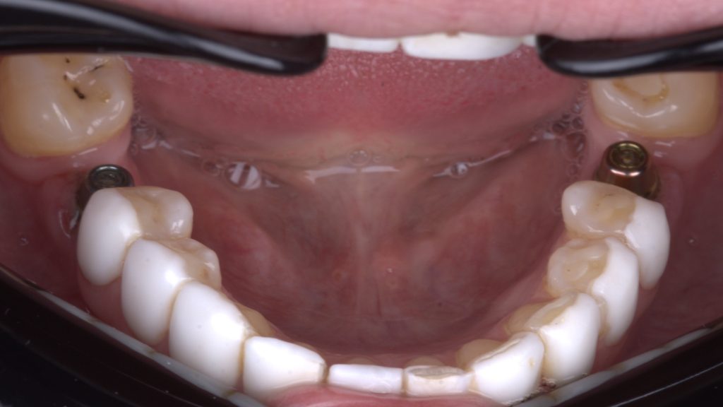 micro flap 1 - Graft Free Implantology