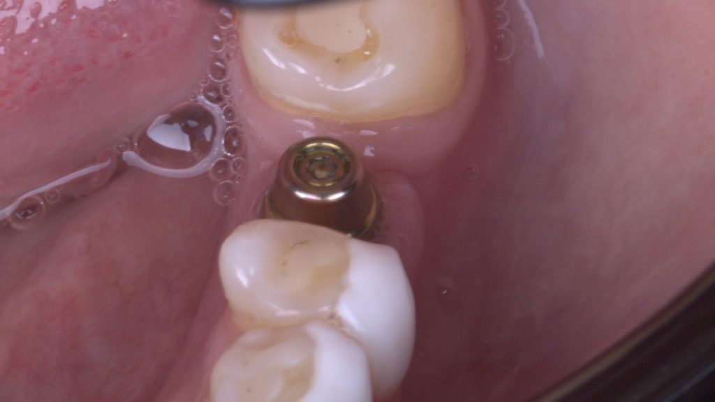 micro flap 2 - Graft Free Implantology