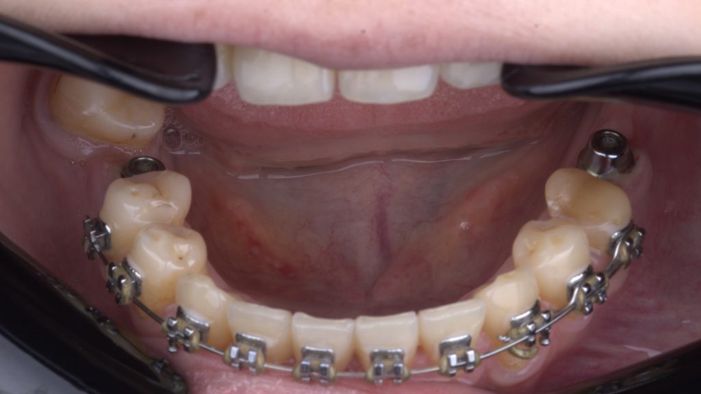 micro flap 3 - Graft Free Implantology