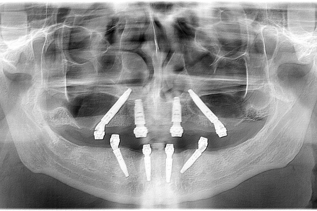 Double All-on-4 surgery Belgrade