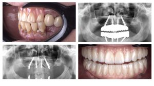 slide - Graft Free Implantology