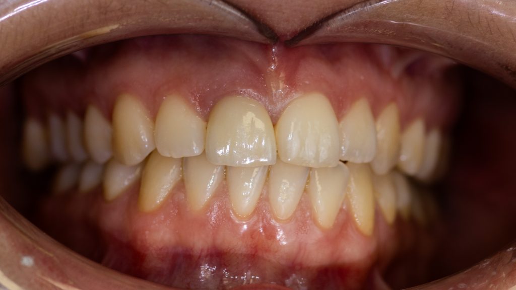 Lithium Disilicate Crown on implant