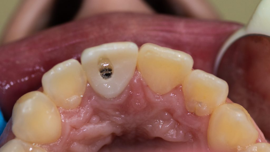 Screw retained crown on implant
