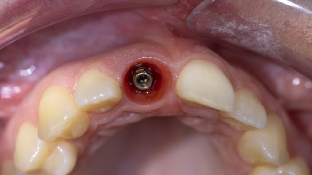 Perfect gingival contour around dental implant