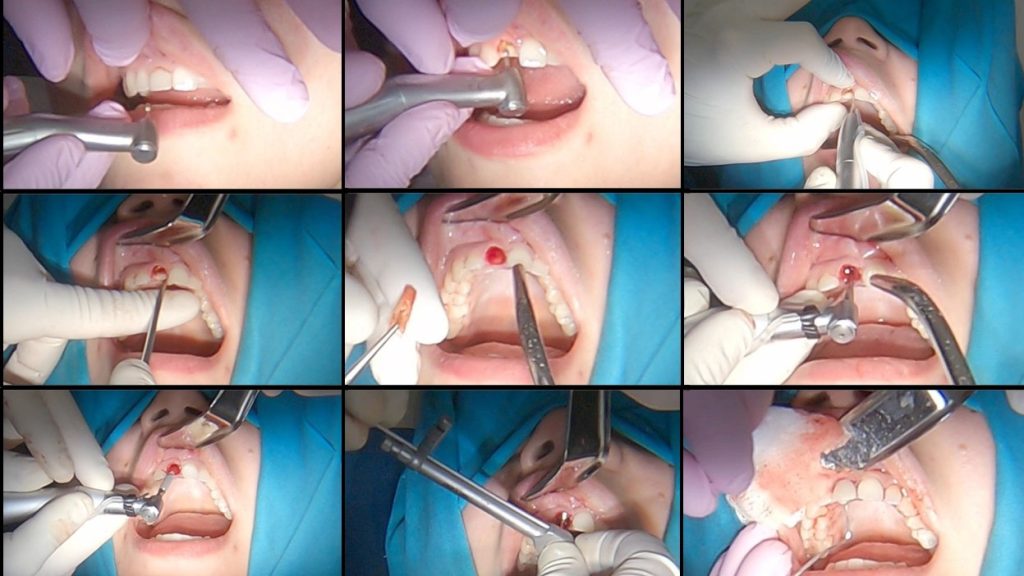 Socket Shield Technique surgery in slides