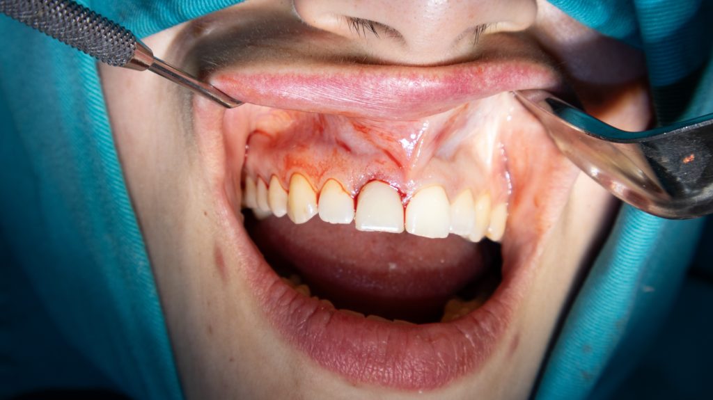 Immediate loading on immediate implant placement.