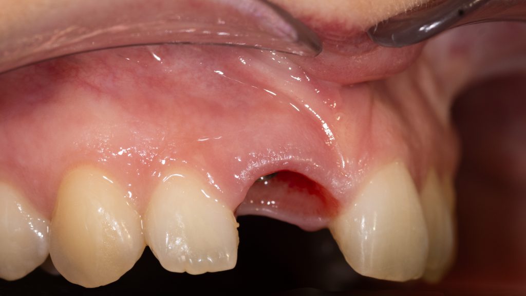 Gingival contour around Neodent implant