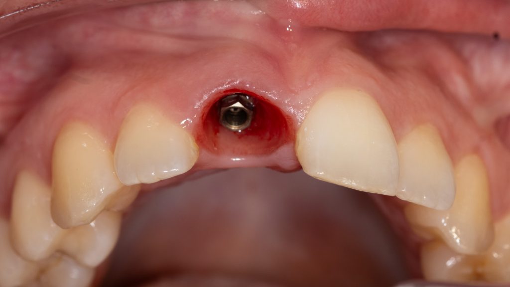 GM exact abutment Neodent Straumann group