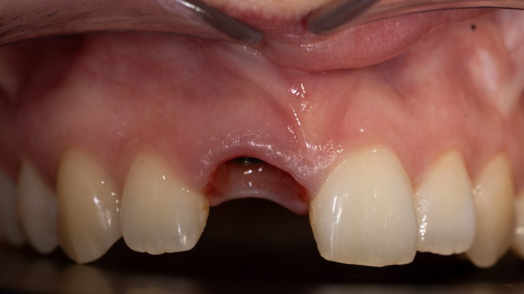 Gingival zenith 