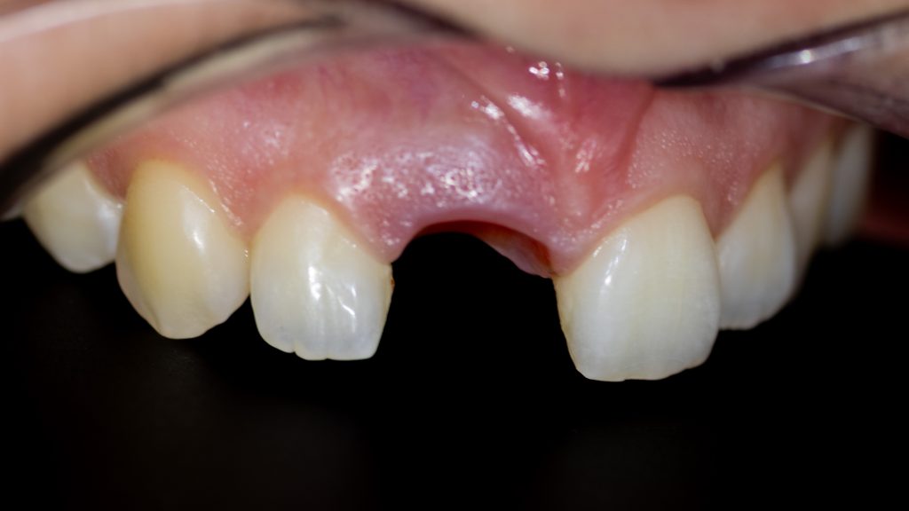 Dental implant gingival zenith