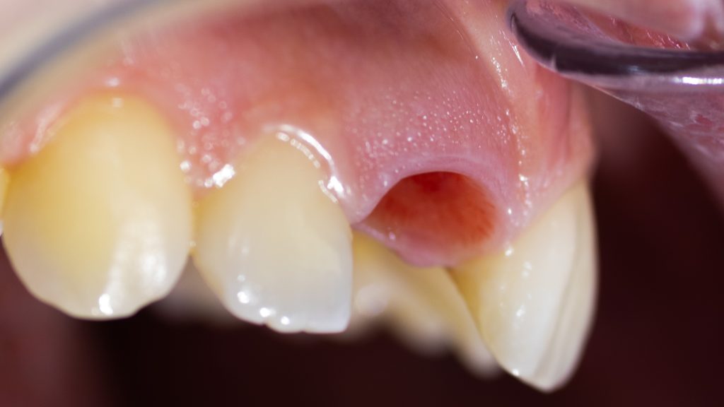 Gingiva texture on dental implant
