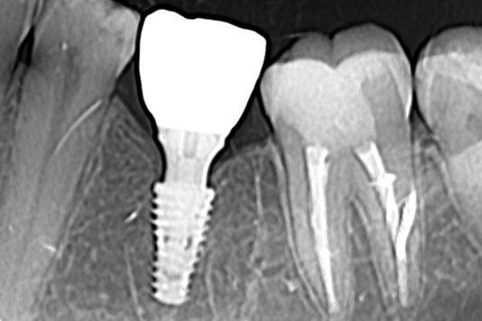 Промена платформе и конкавни абатмент са довољном висином десне ивице обезбеђују савршено обнављање кости.