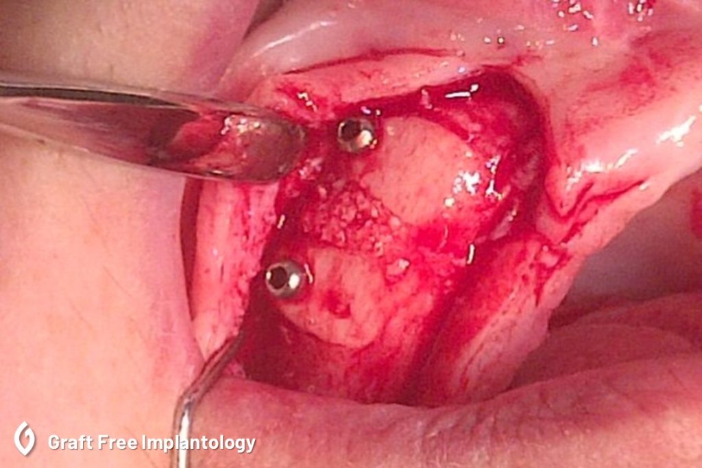 Zygomatic buttress block graft