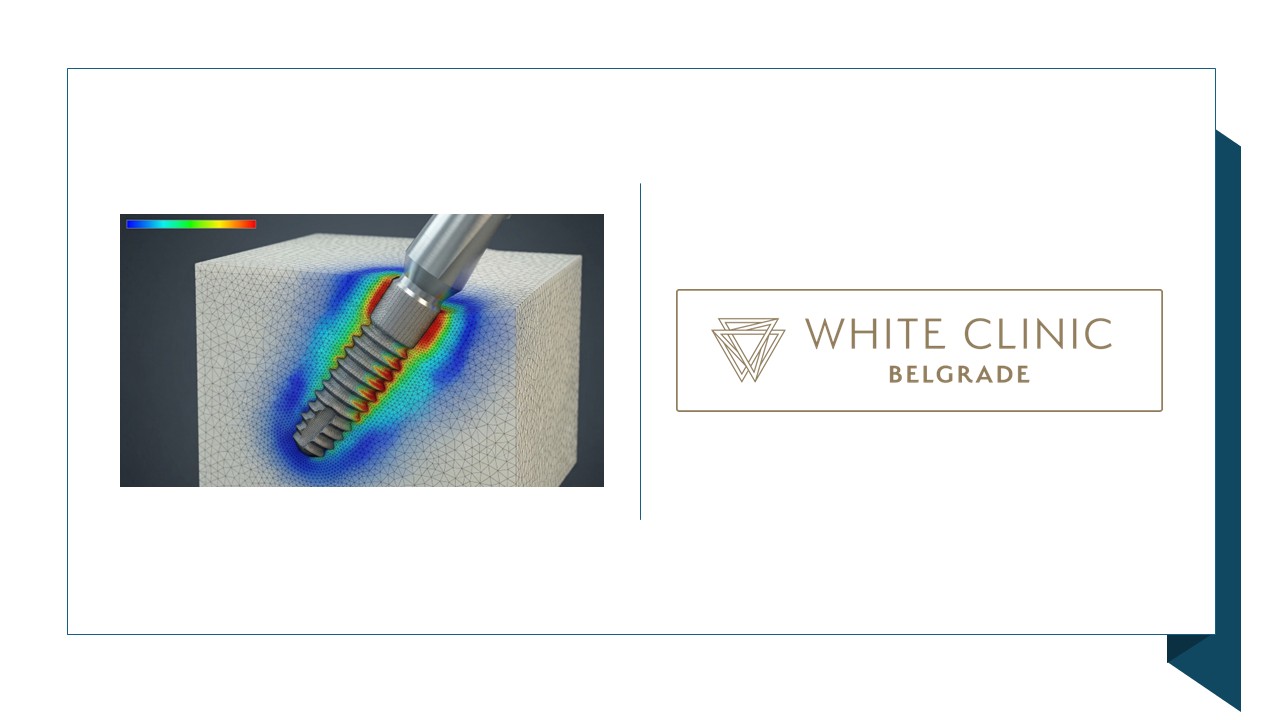 Prosthetic Aspect of Implant Angulation in the All-on-4 Concept: Load Biomechanics and the Influence of Lateral Forces