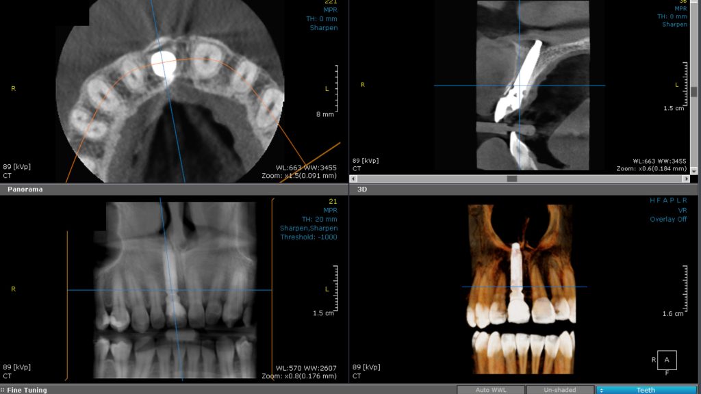 CBCT imaging of implant