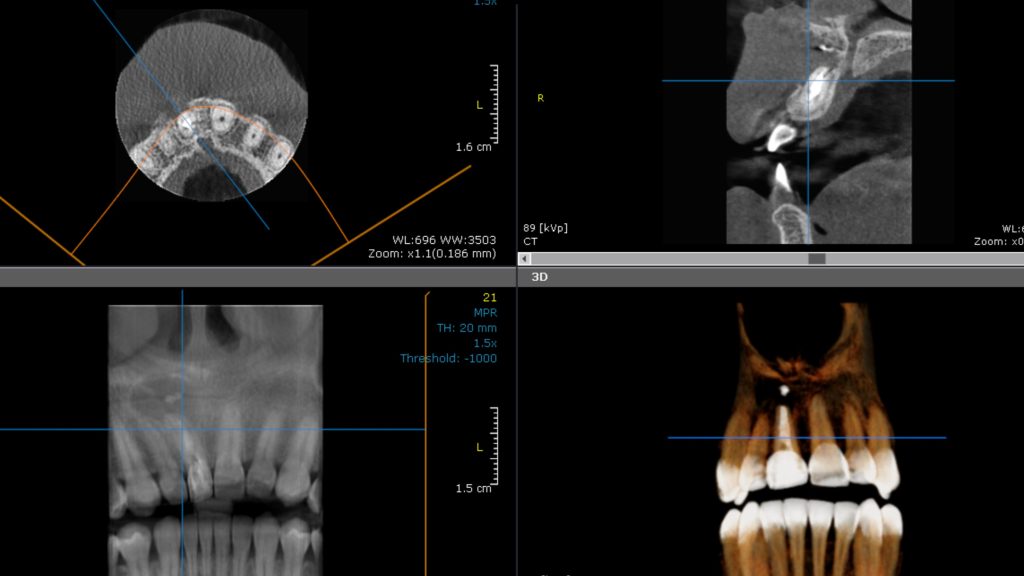 Maxillary cyst 