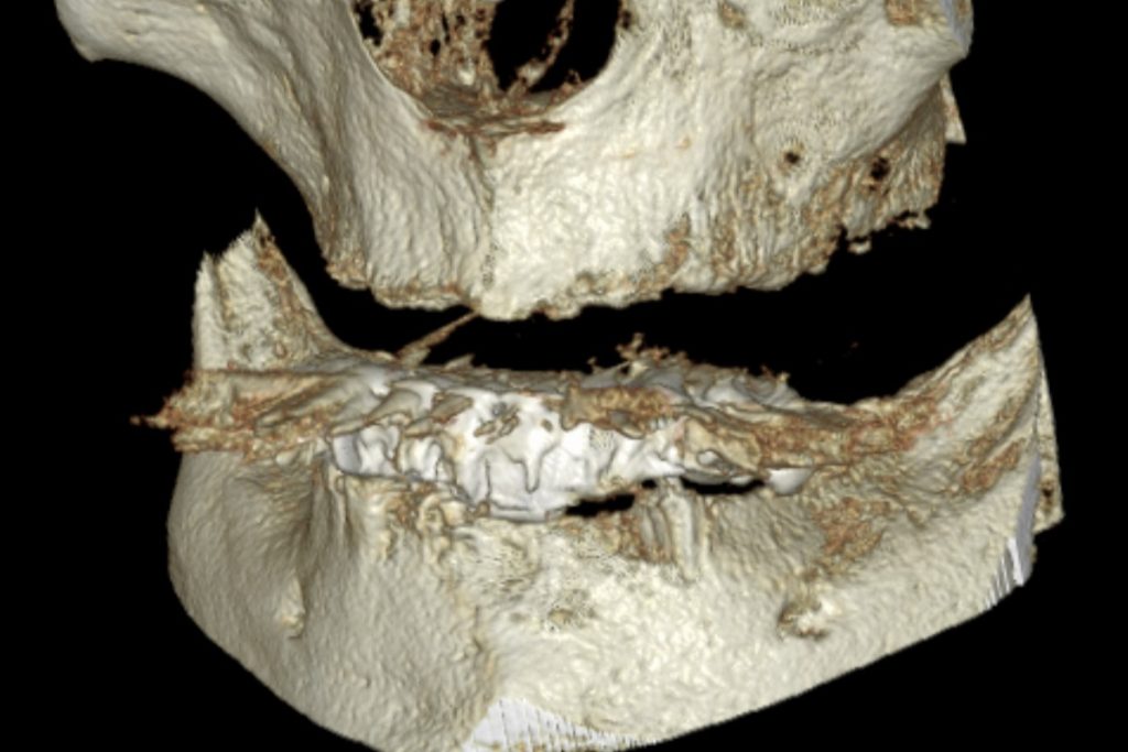 CBCT rendering of upper and lower jaw